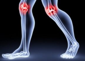 Razones para desarrollar artrosis de rodilla