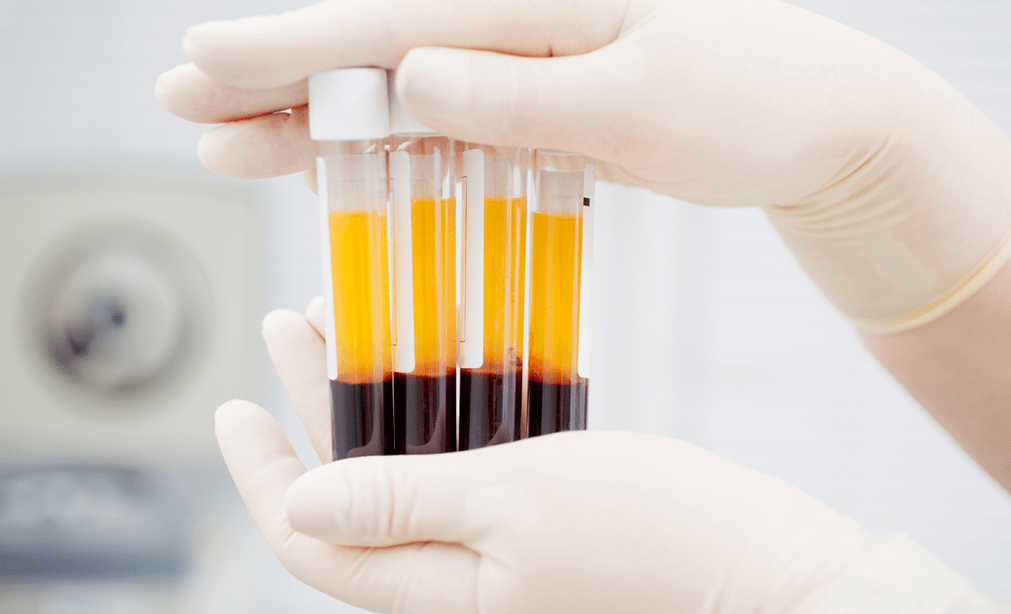 Plasma rico en plaquetas para la terapia con PRP para la osteoartritis